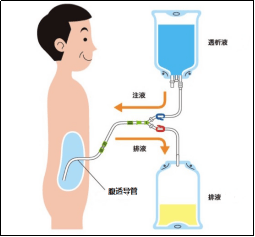 腹膜透析是利用人体自身的腹膜为透析膜,通过向腹腔注入腹膜透析液,与