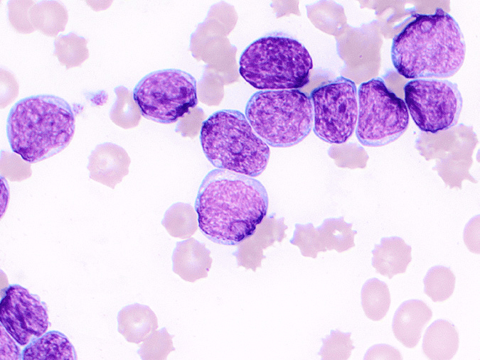 这3种白细胞肿瘤疾病的细胞学发现,临床意义与预后,你都掌握了吗?