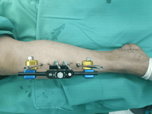 骨搬移手术让"糖友"们向截肢说不