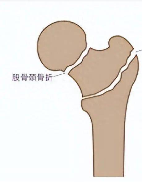 原来是"它"在作祟…_大哥_水泥_股骨