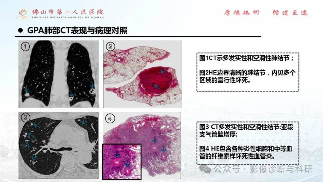 【ppt】anca相关性血管炎分类及肺部ct表现