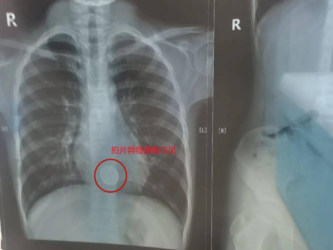 9岁儿童误吞一元硬币，胃镜下巧取异物化解危机_搜狐网