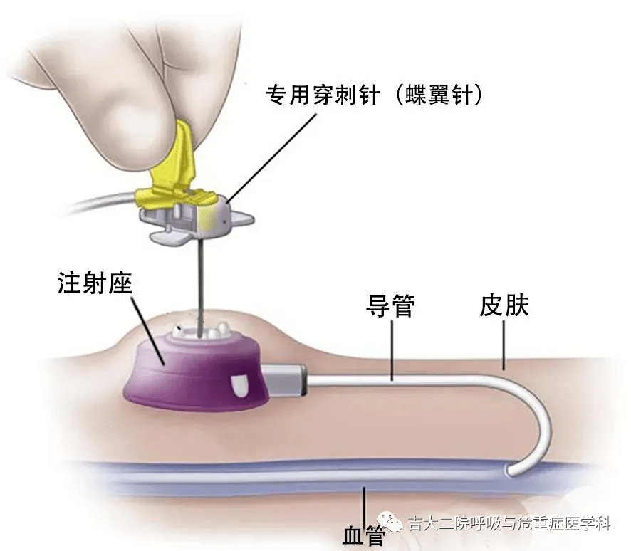 输液港固定图片图片