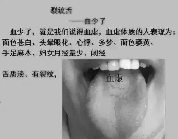 出现裂纹舌最常见的10大原因,一一为你解答!