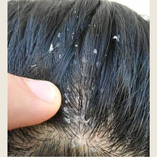 用什么洗头膏去头皮屑最有效?可以的去屑洗发水介绍