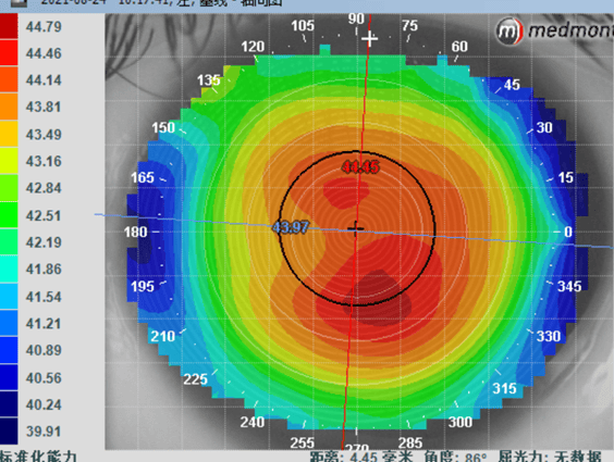 常见角膜地形图图片