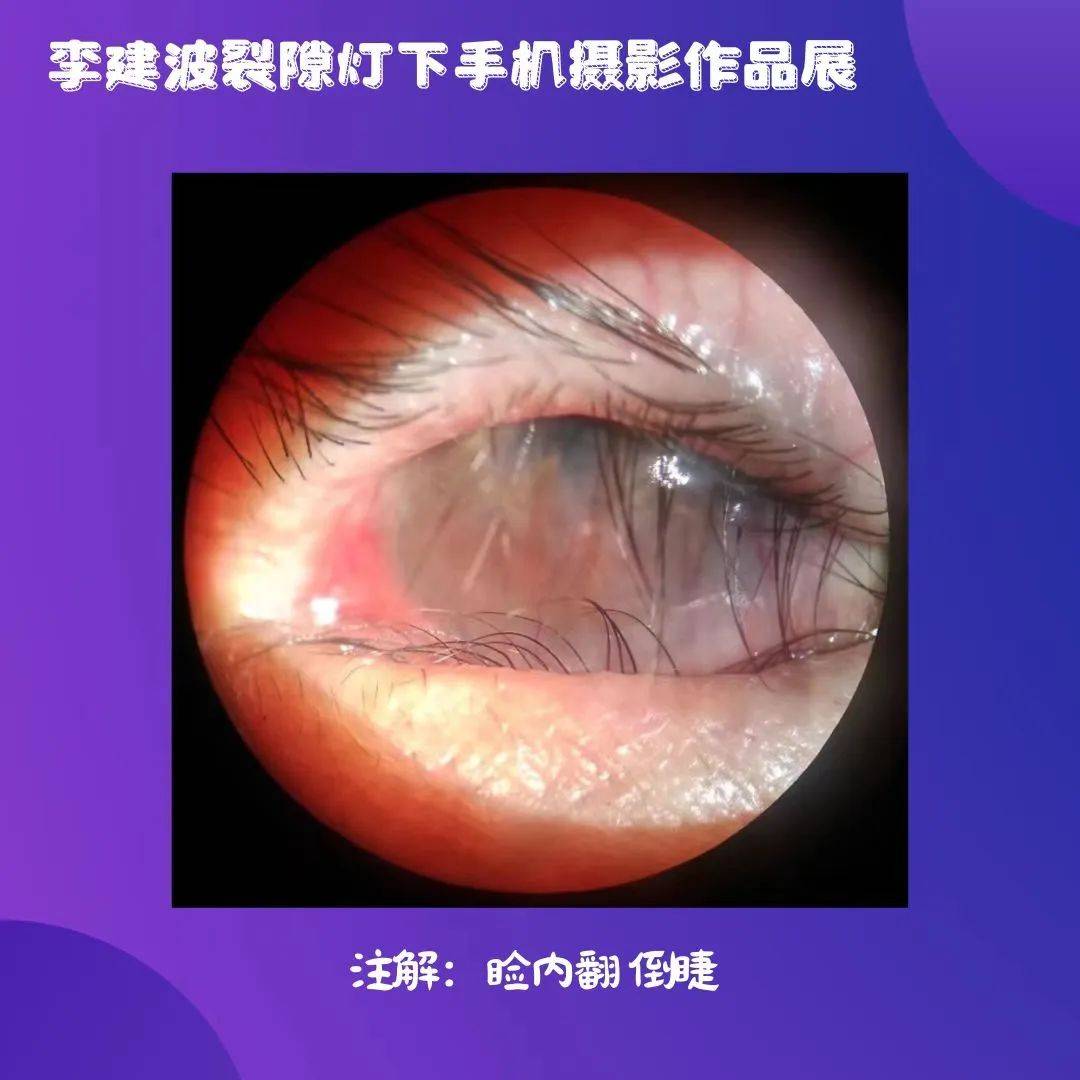 《眼病图谱》精选36张