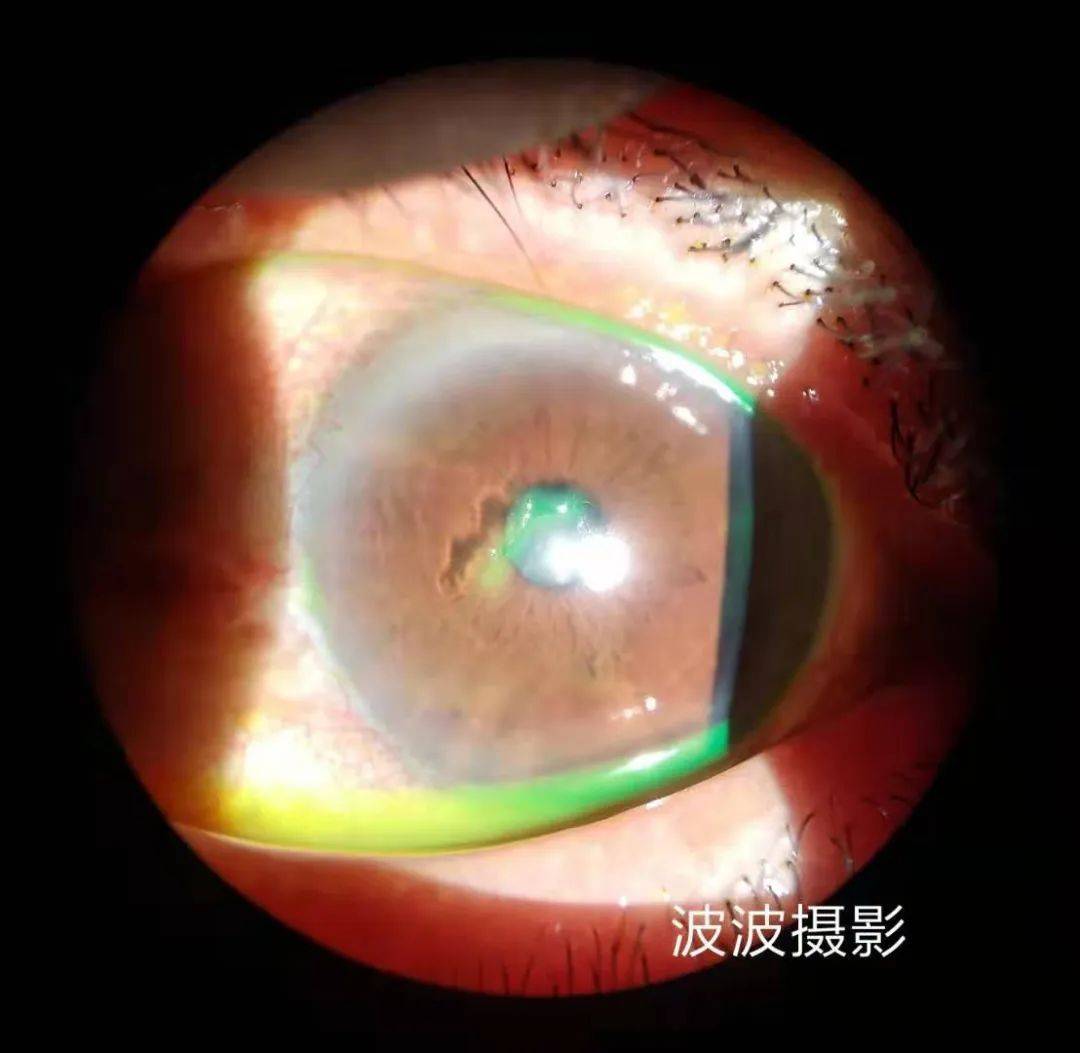 眼科图谱100张 | 裂隙灯下眼科图片分享_角膜_秘籍_医生