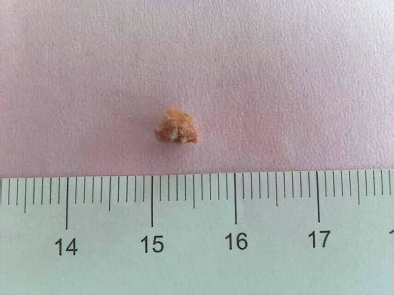 肾结石总复发，就用“三金两石”方，5味药溶石排石，免手术之苦