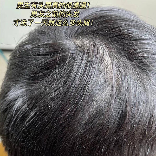 去屑蓬松洗发水介绍_头皮_问题_头发