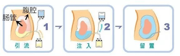 日间非卧床腹膜透析 (dapd)透析液白天在腹腔内留置4