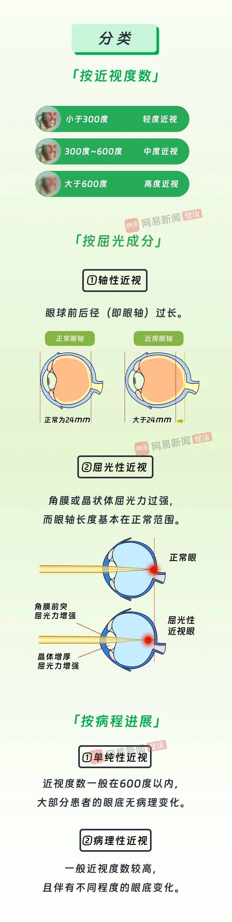 一图读懂:近视矫正方法大比拼,看看哪个适合你?