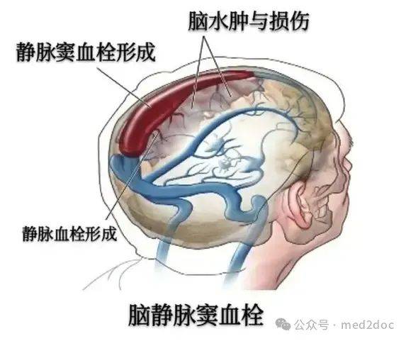 脑栓塞示意图图片