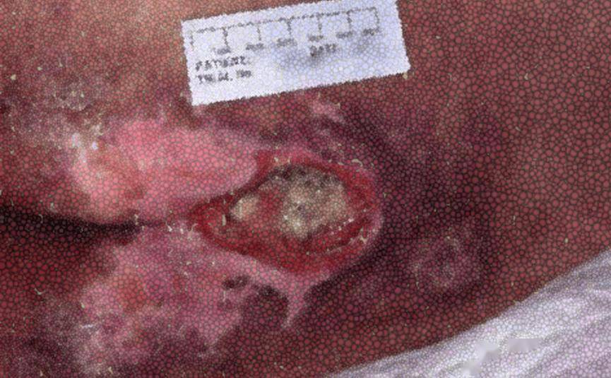 尾椎骨皮肤溃烂图片图片