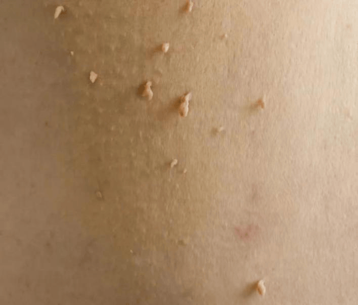 例如扁平疣,寻常疣,痣等.