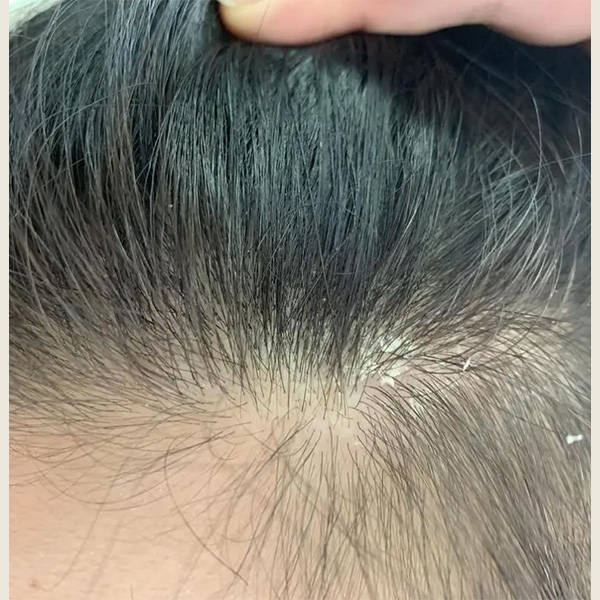 儿童洗发水去头皮屑有哪些?男女通用去屑洗发水介绍