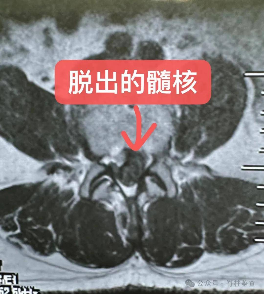 终板炎怎么治疗图片