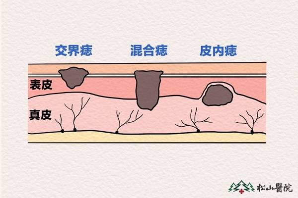 痣可能会癌变?松山医院 5点自测危险程度