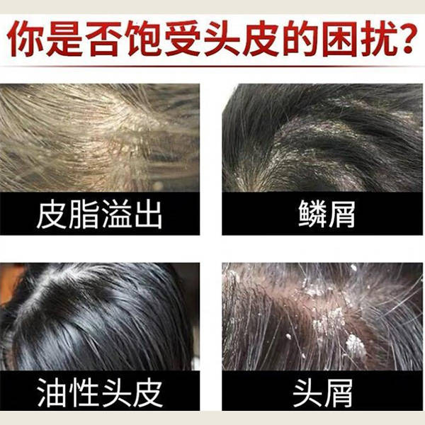 头皮屑为什么多 头皮屑为什么多