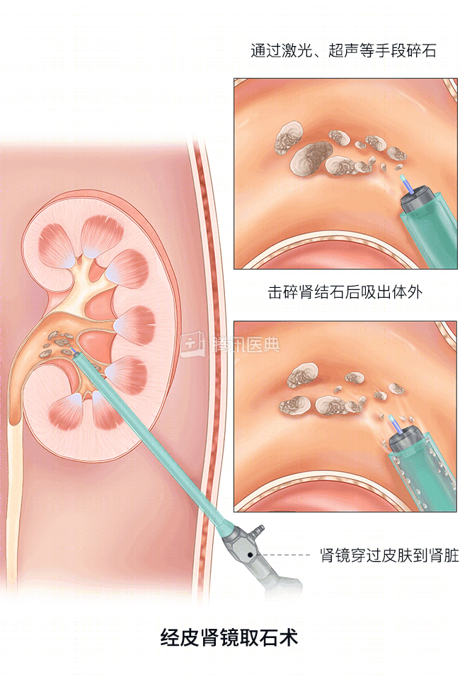 肾结石激光碎石图片