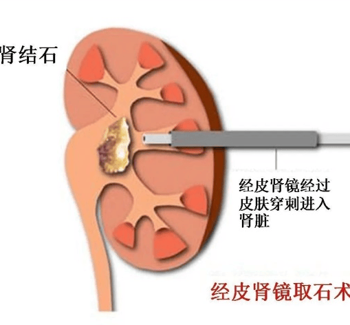 —我院成功开展一例经皮肾镜肾结石钬激光碎石