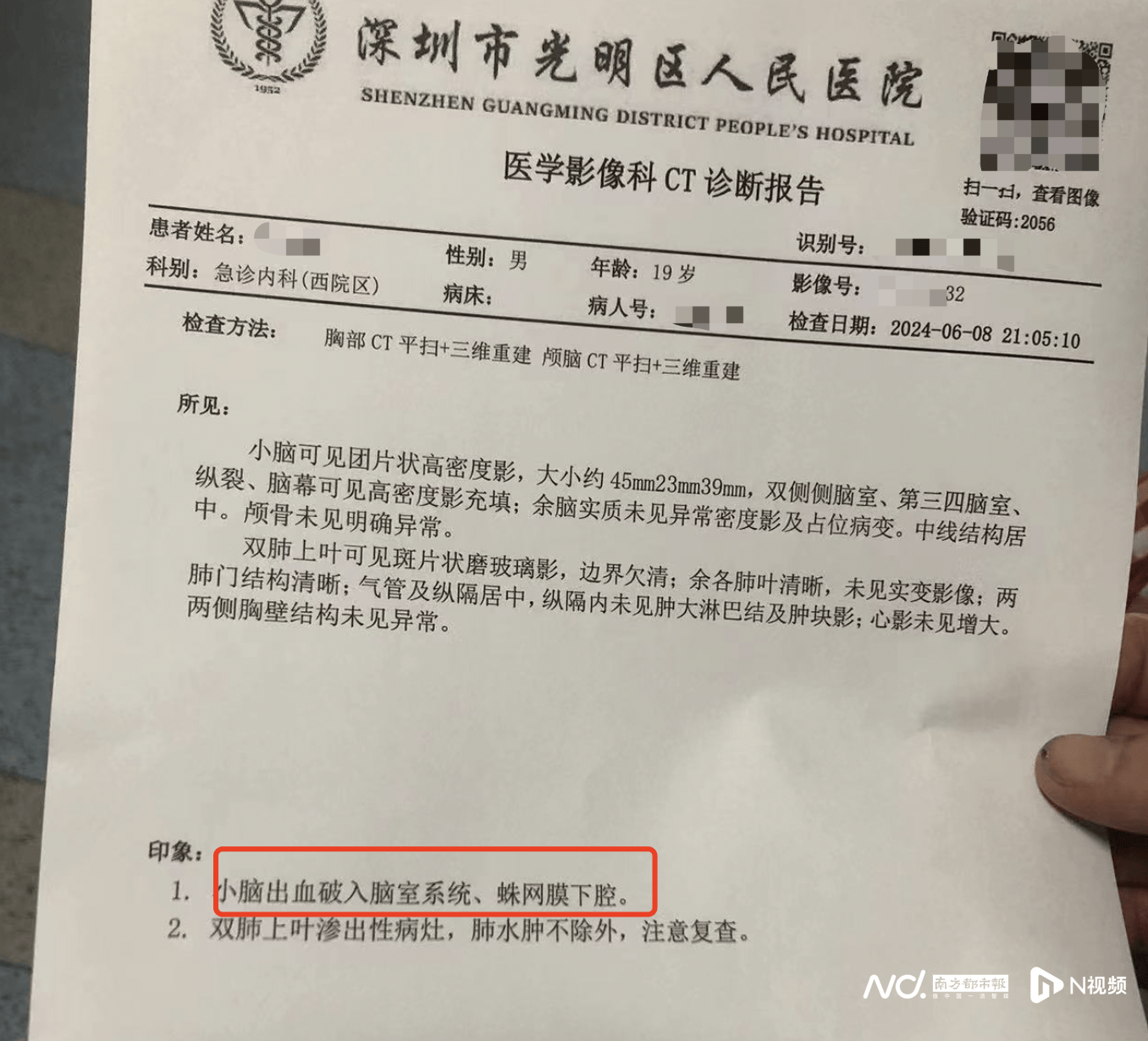 一份来自光明区人民医院的ct诊断证明显示,患者李杰小脑出血破入脑室