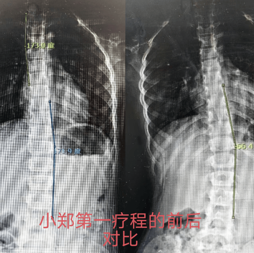 "脊柱侧弯"暑期集训营又开始了,一起来挺直腰板吧!