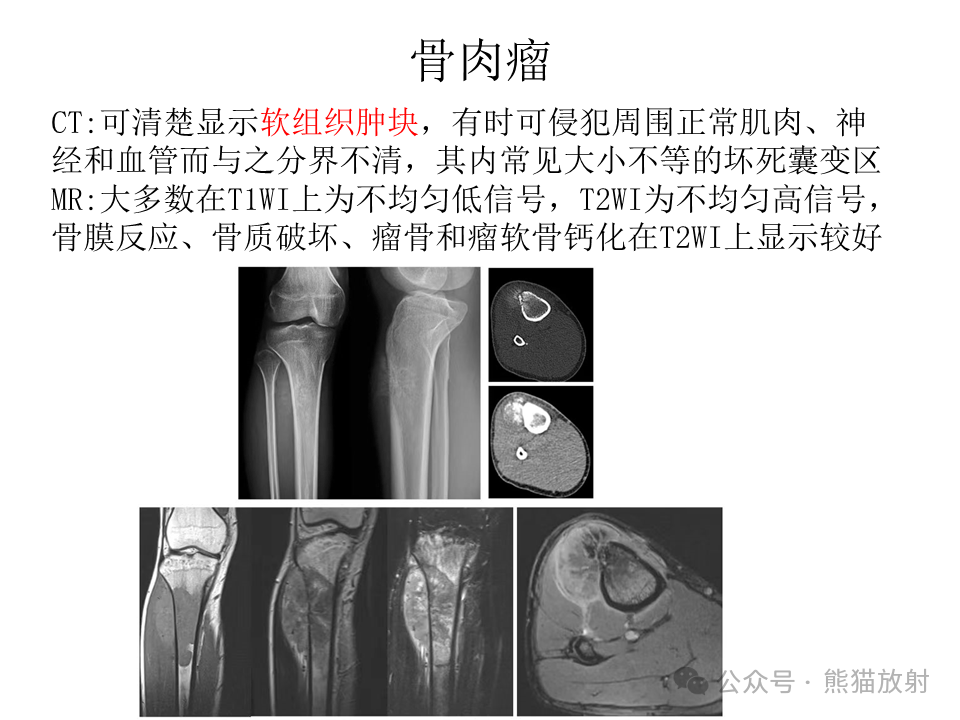 股骨软骨瘤图片