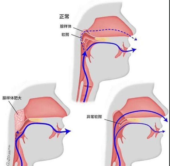 【迁医健康】纠结 孩子腺样体肥大 到底要不要切?