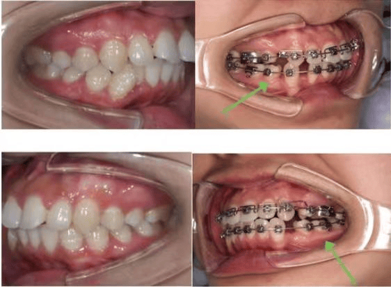 口腔正畸,这些知识要知道.