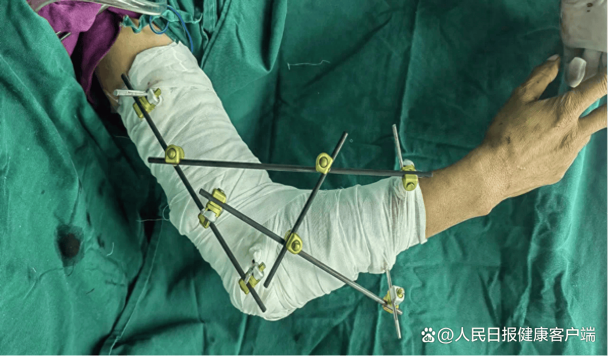 图13天前,远在新疆和田地区皮山县的麦迪,在家修剪果树时不慎滑落电锯