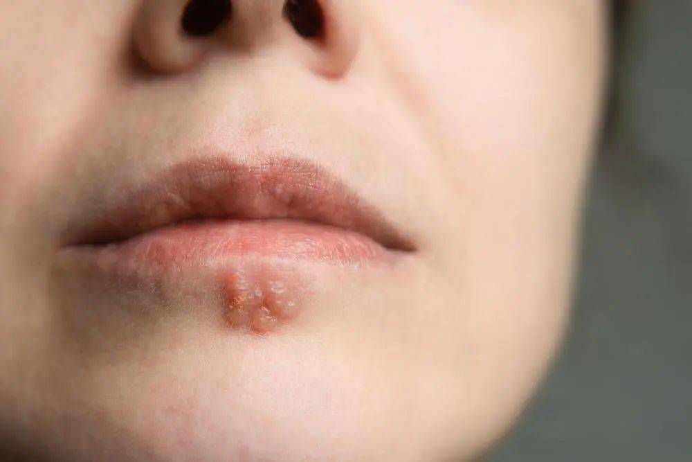 有数据显示,感染了1型单纯疱疹病毒后,20%~40%的人会在嘴唇和口周区域