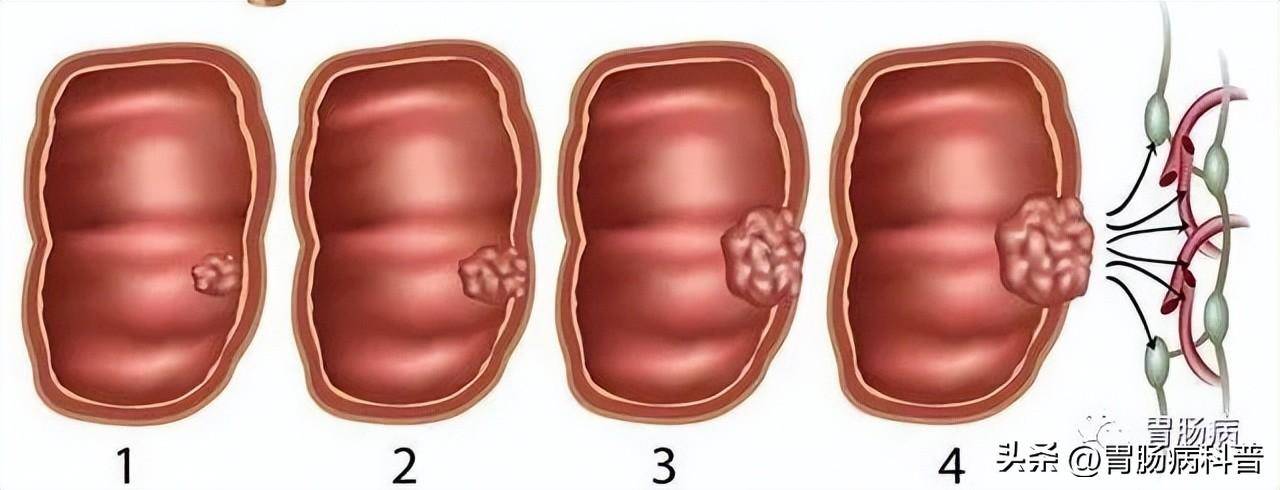 结肠癌早期大便形状图片