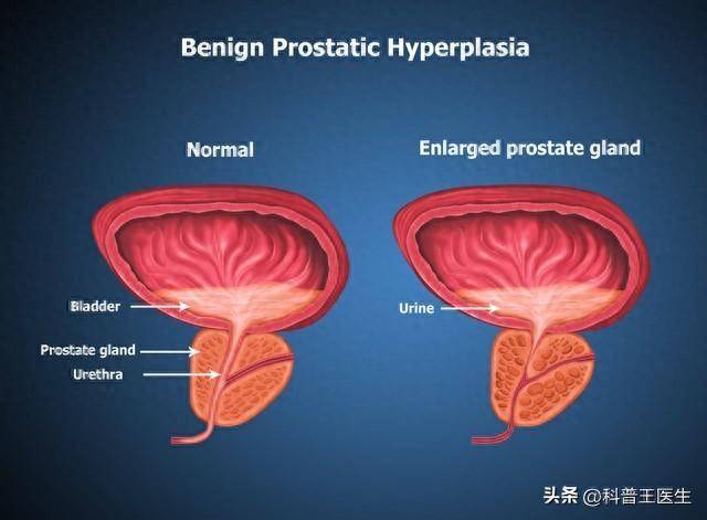 【热点关注】前列腺增生能治好吗?专家揭秘治疗新希望!_患者_生活_药物