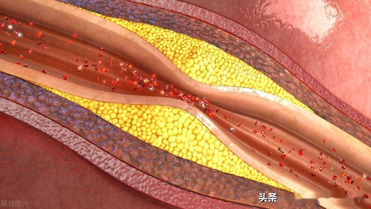 动脉粥样硬化斑块是怎样长成的?