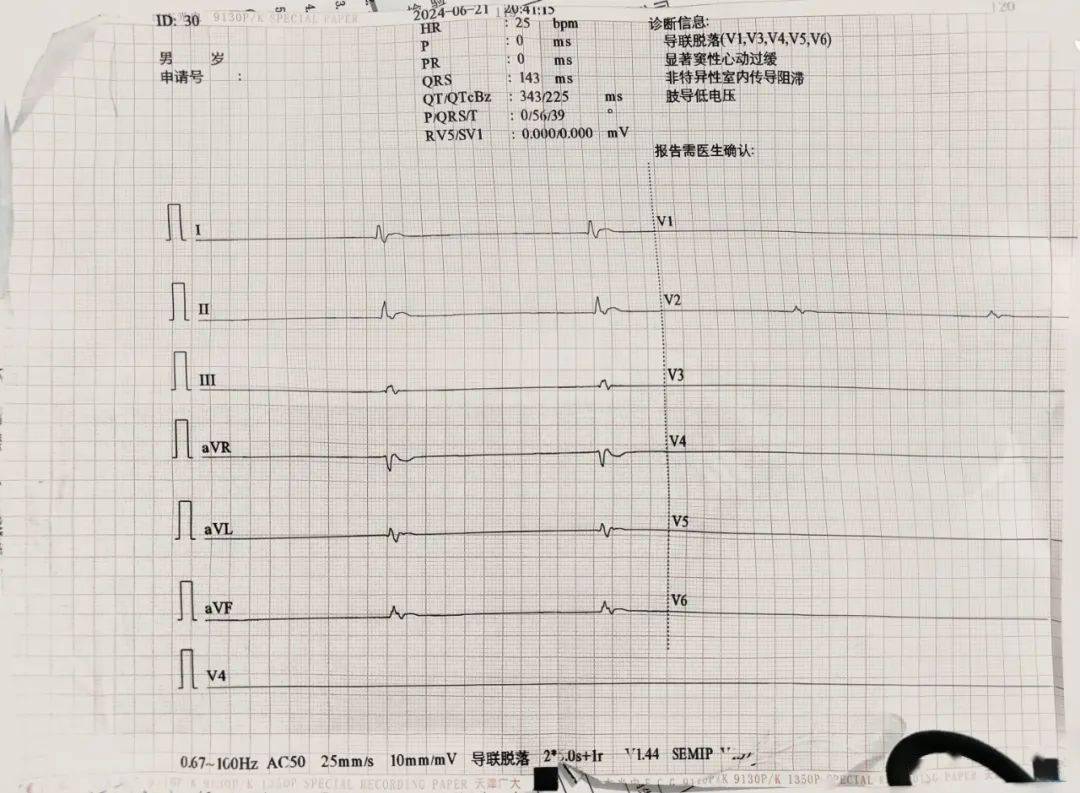 临床死亡心电图表现