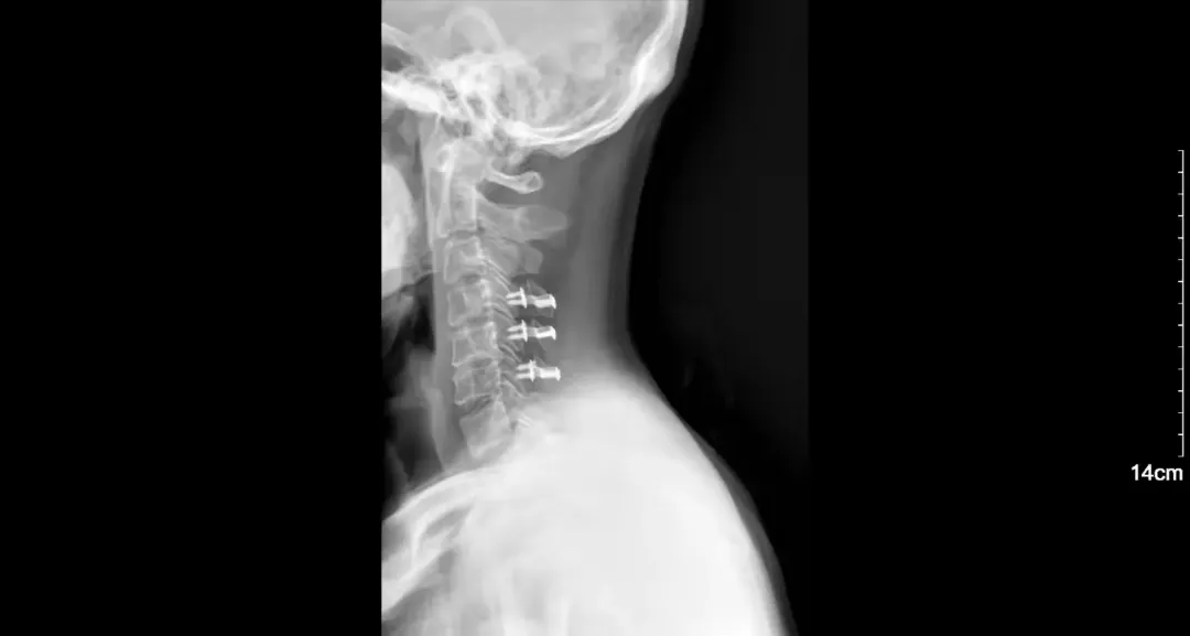 脊柱外科收治一例因车祸伤导致非骨折脱位型颈部脊髓损伤并高位截