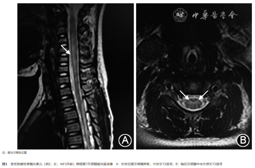 脊髓炎核磁共振图片