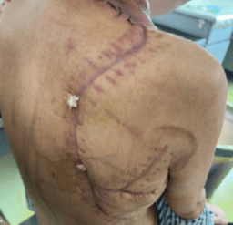 "坏死性筋膜炎"重症患者家属为青岛市城阳区人民医院烧伤科送上感恩