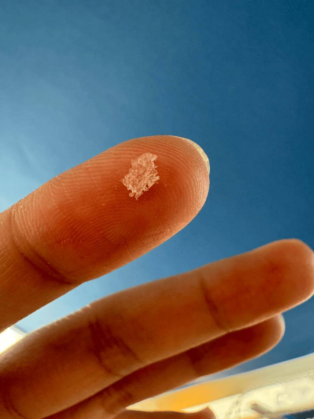 是不是每个人都能从头皮里抠下来硬硬的结痂啊