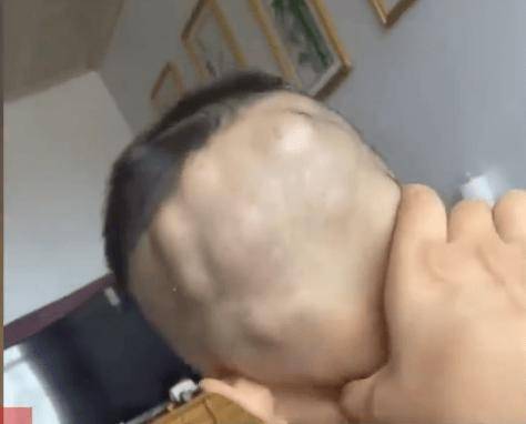 2岁幼童满头大包如"核桃"?警惕!夏天很多人中过招