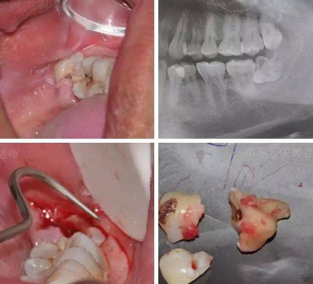 拔智齿过程图图片