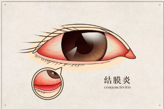 【健康科普】相见时,不一定红着脸,但一定不能红着眼……红眼病进入