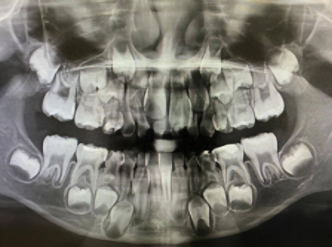 牙齿也会"躲猫猫"?8岁男孩门牙2年未长出,竟然是这个原因!