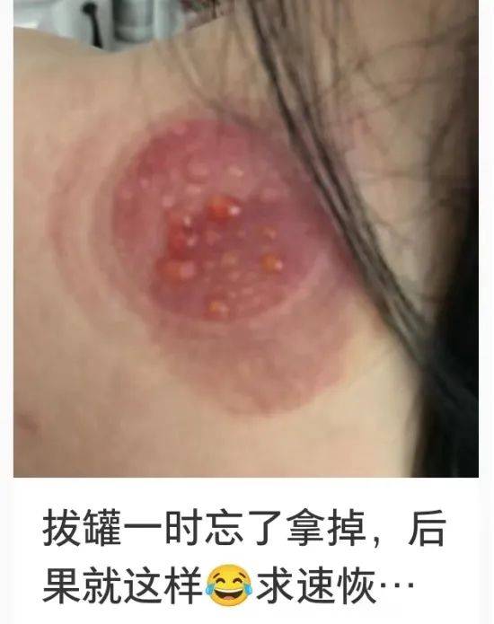 一男子后背密密麻麻.医生紧急提醒