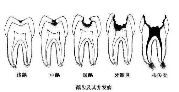 牙髓位置图图片