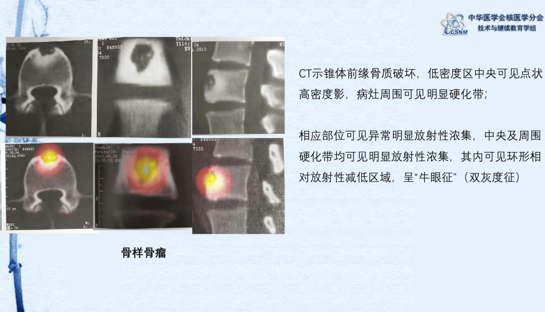 骨癌片子图片