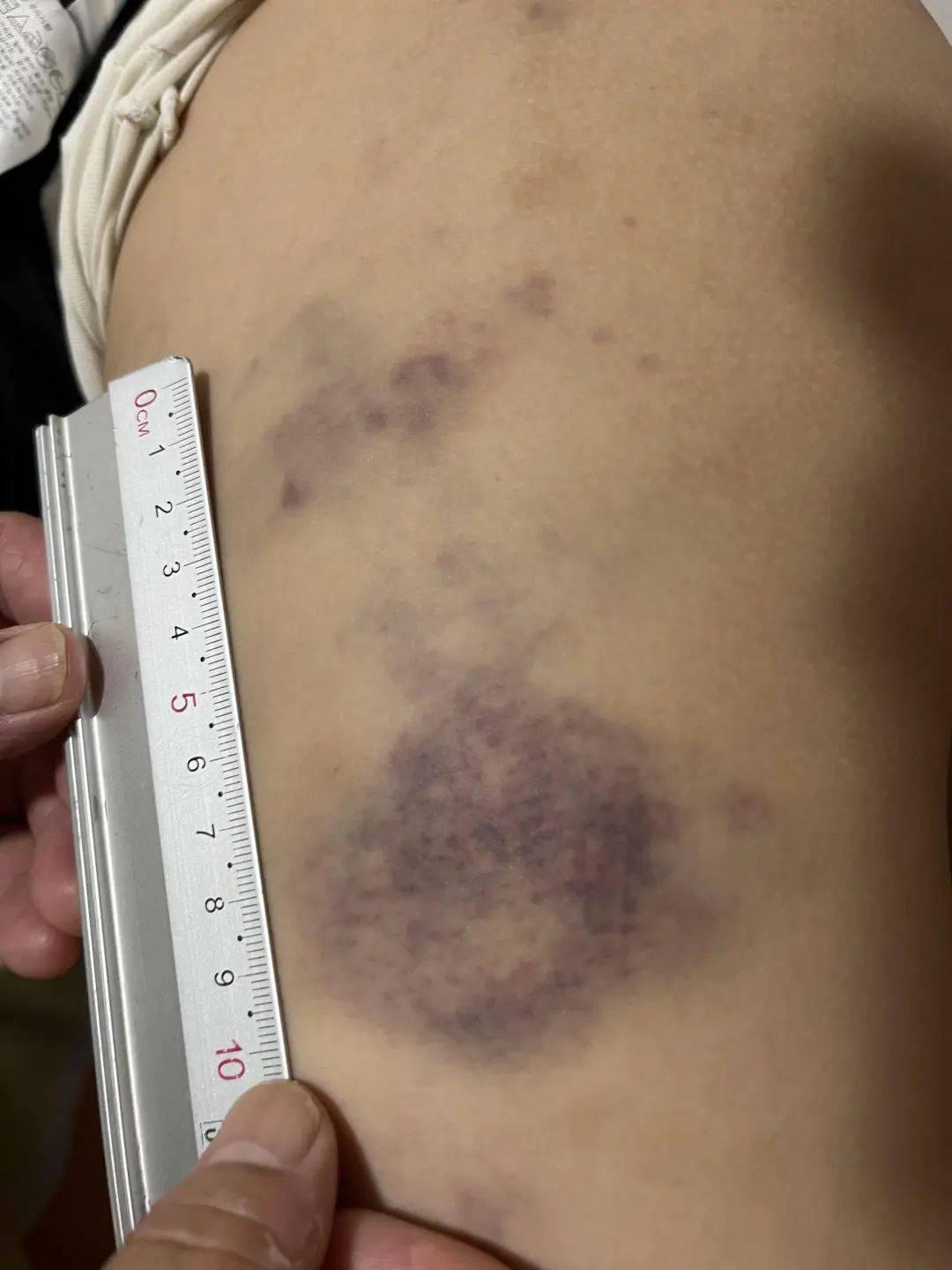 青岛10岁男童遭托管班教师殴打,身体大片淤青 涉事老