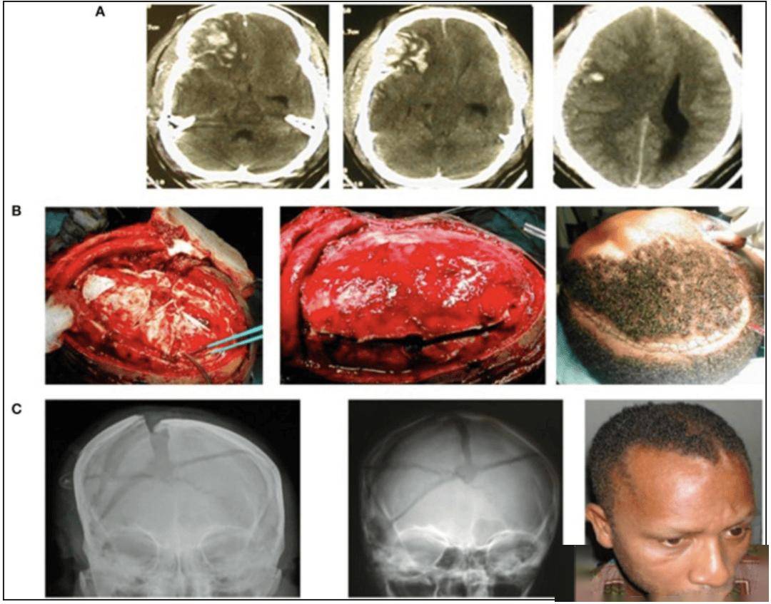 开颅手术后,医院竟把患者头骨搞丢了,还要收 104 万天价医疗费