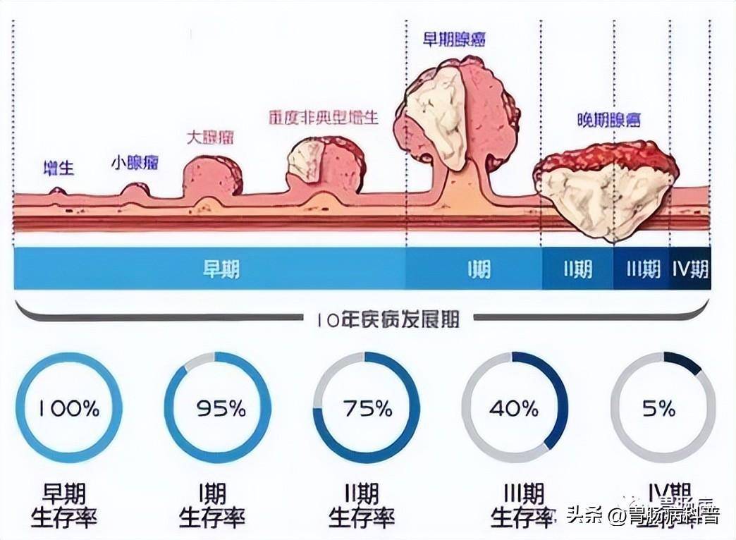 大肠癌的早期症状就是没有症状